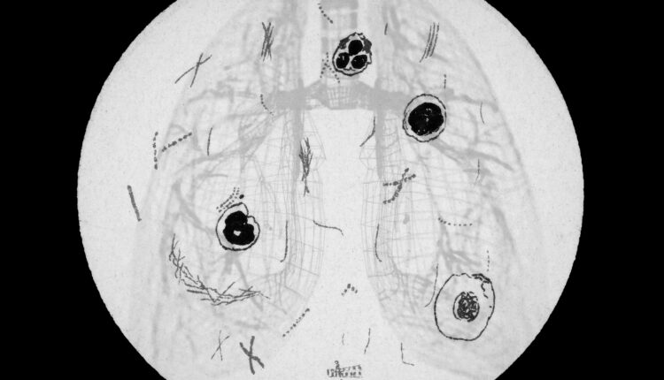 A photo illustration shows a black and white diagram of lungs superimposed over an old chromolithograph illustration of tuberculosis bacteria. The illustration in bordered by a dark black circle.